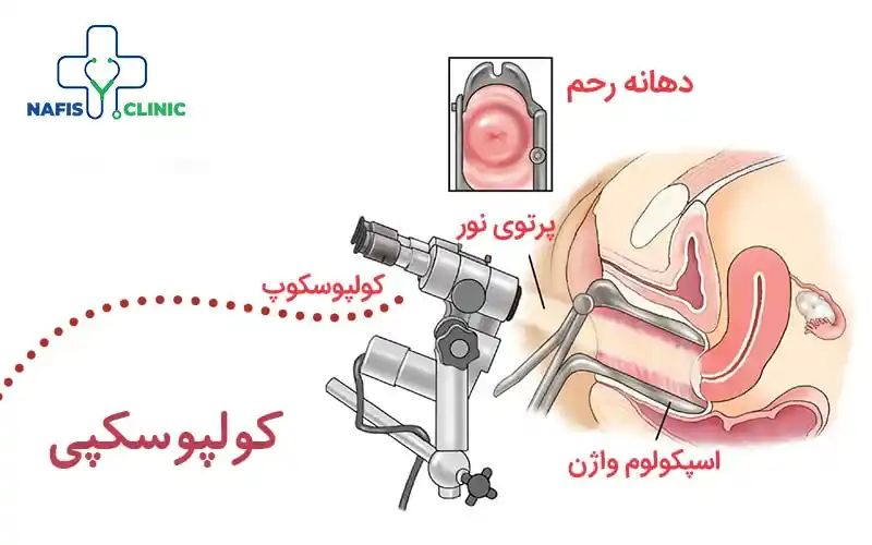 کولپوسکوپی