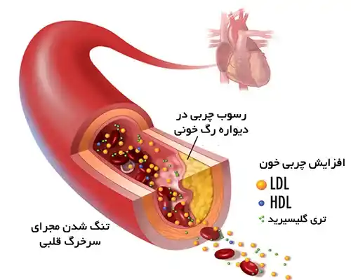 چربی خون بالا