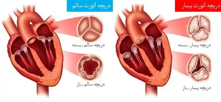 والولوپلاستی