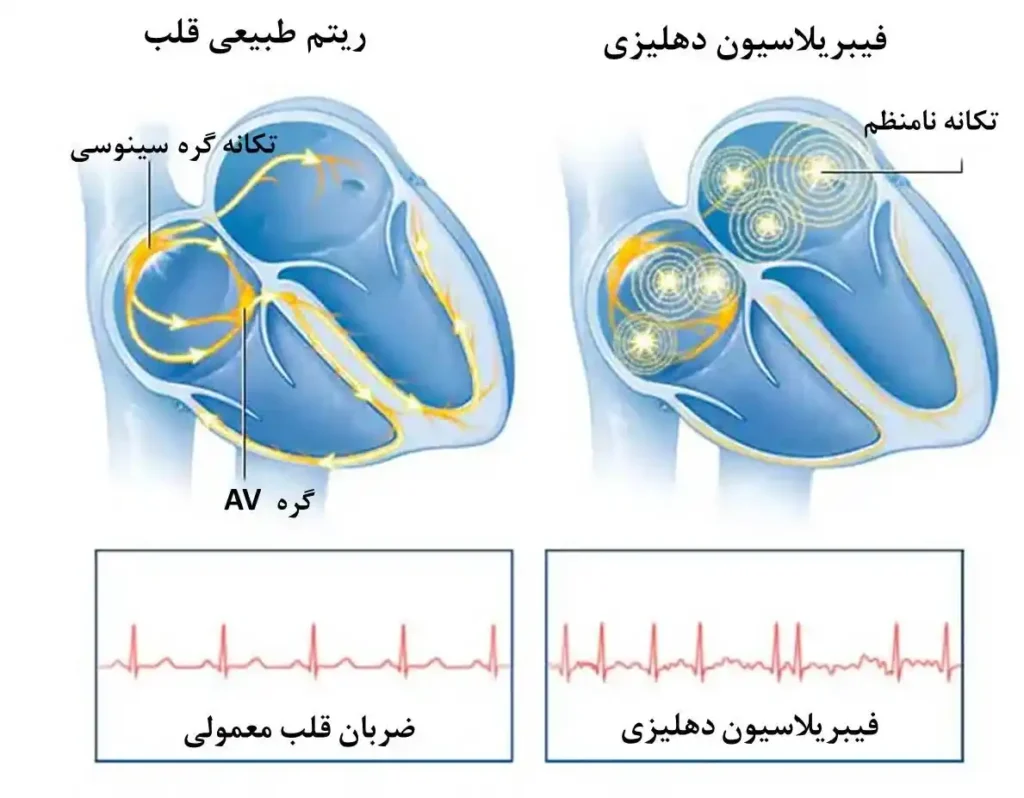 فیبریلاسیون دهلیزی