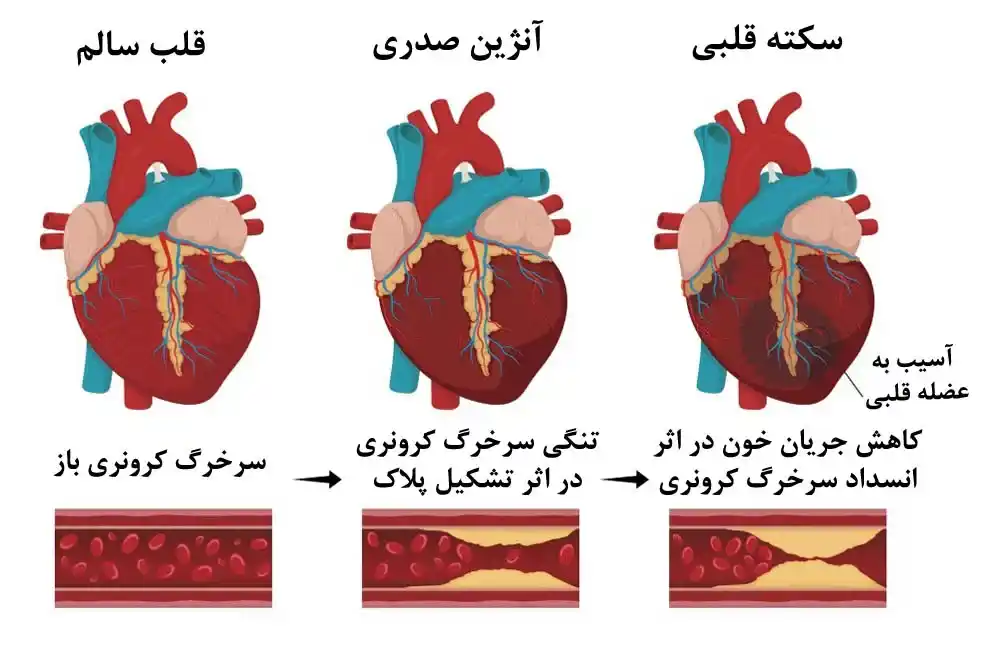 تیر کشیدن قلب