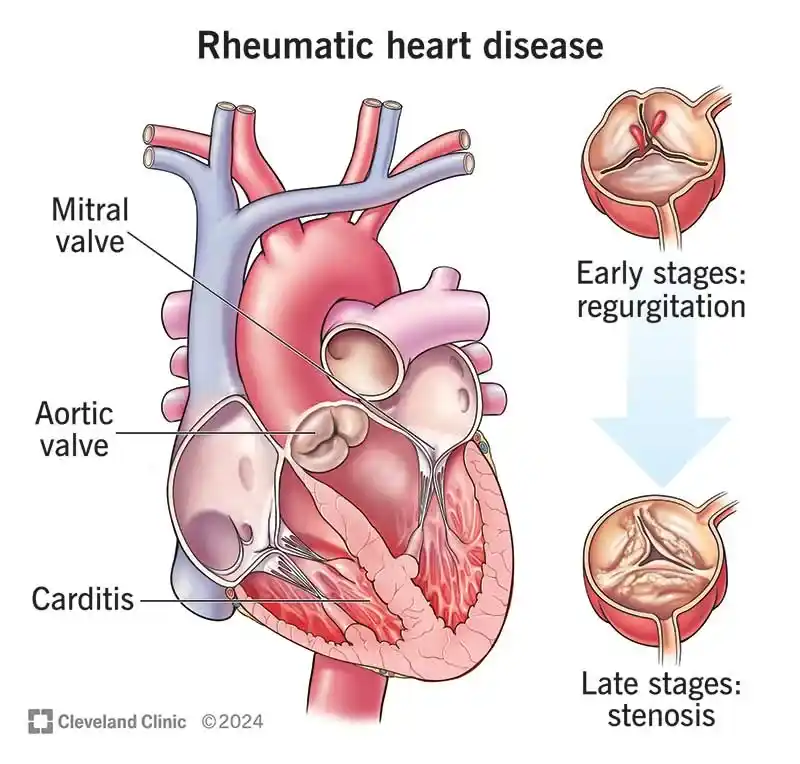 روماتیسم قلبی