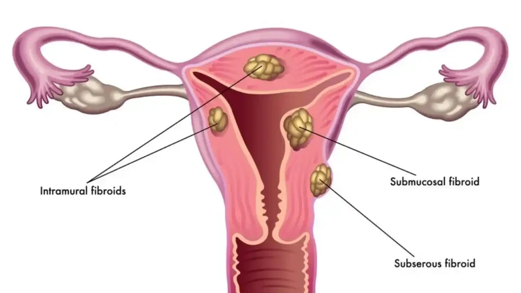 فیبروم رحم 