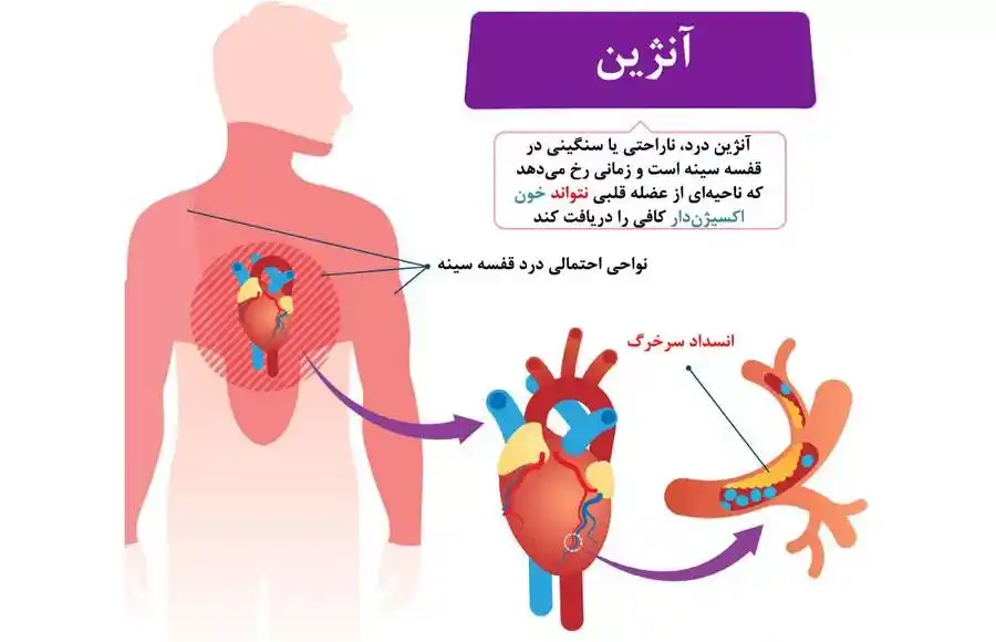 آنژین قلبی