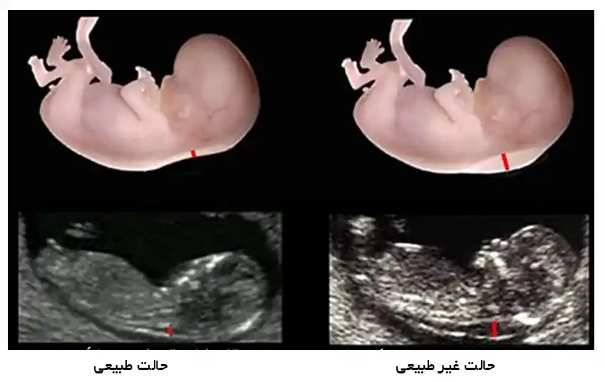 غربالگری بارداری