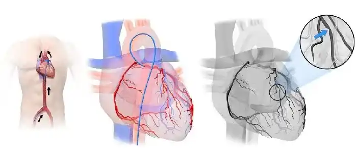 کاتتریزاسیون قلبی