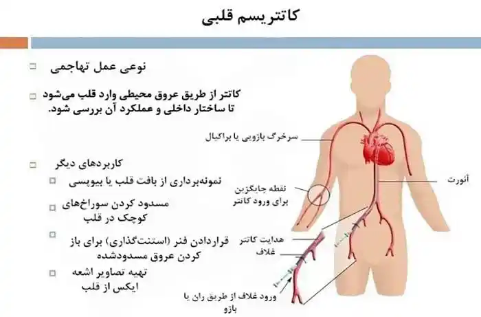 کاتتریزاسیون قلبی