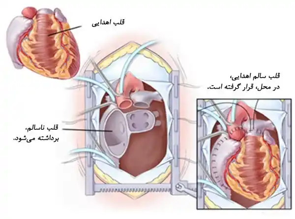 پیوند قلب 