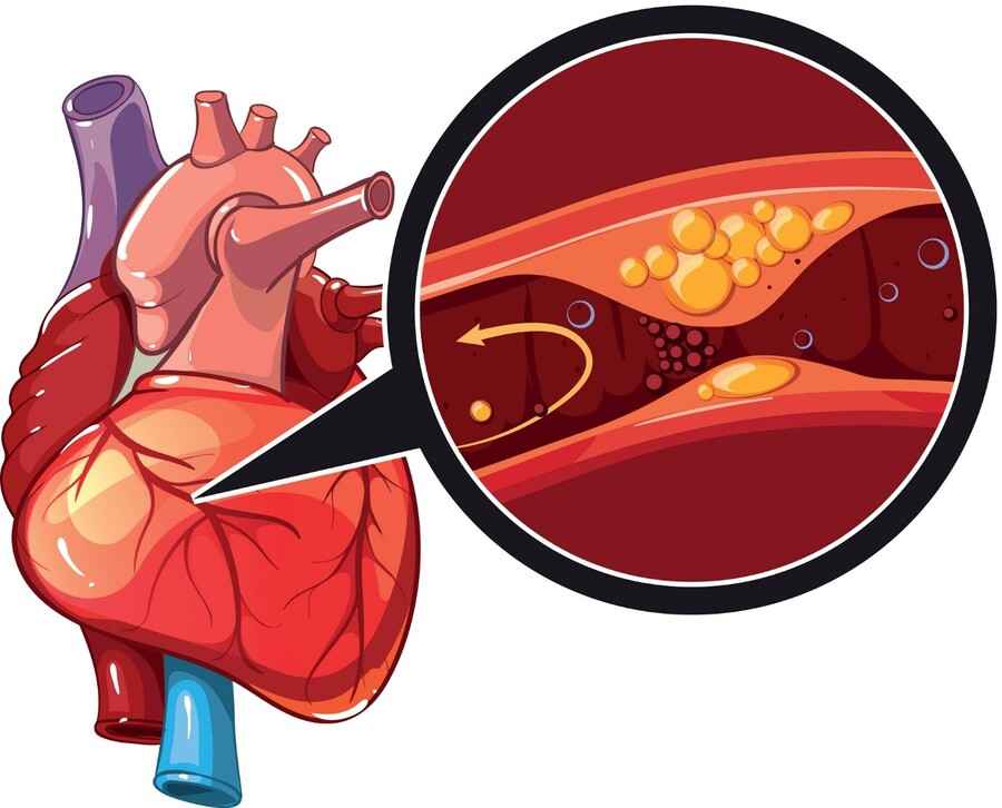 آنژین قلبی